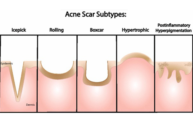 Deep Acne Scar Laser Treatment Regalion Clinic Damansara