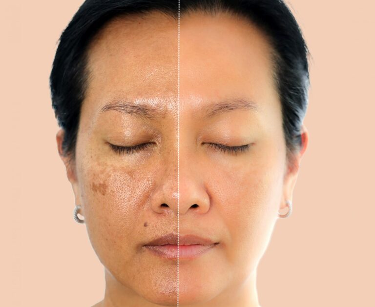 Rawatan Laser Lebih Baik daripada Chemical Peel untuk Hilangkan Jeragat?